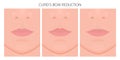 Face front_Cupid Bow Reduction 2